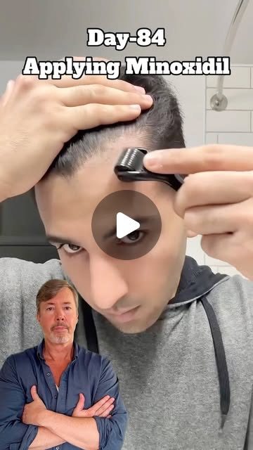 Instagram reel by @spencerkobren: ⚠️ Hair Loss Warning: Dermarolling Could Be Causing Permanent Damage ⚠️ Many young men are